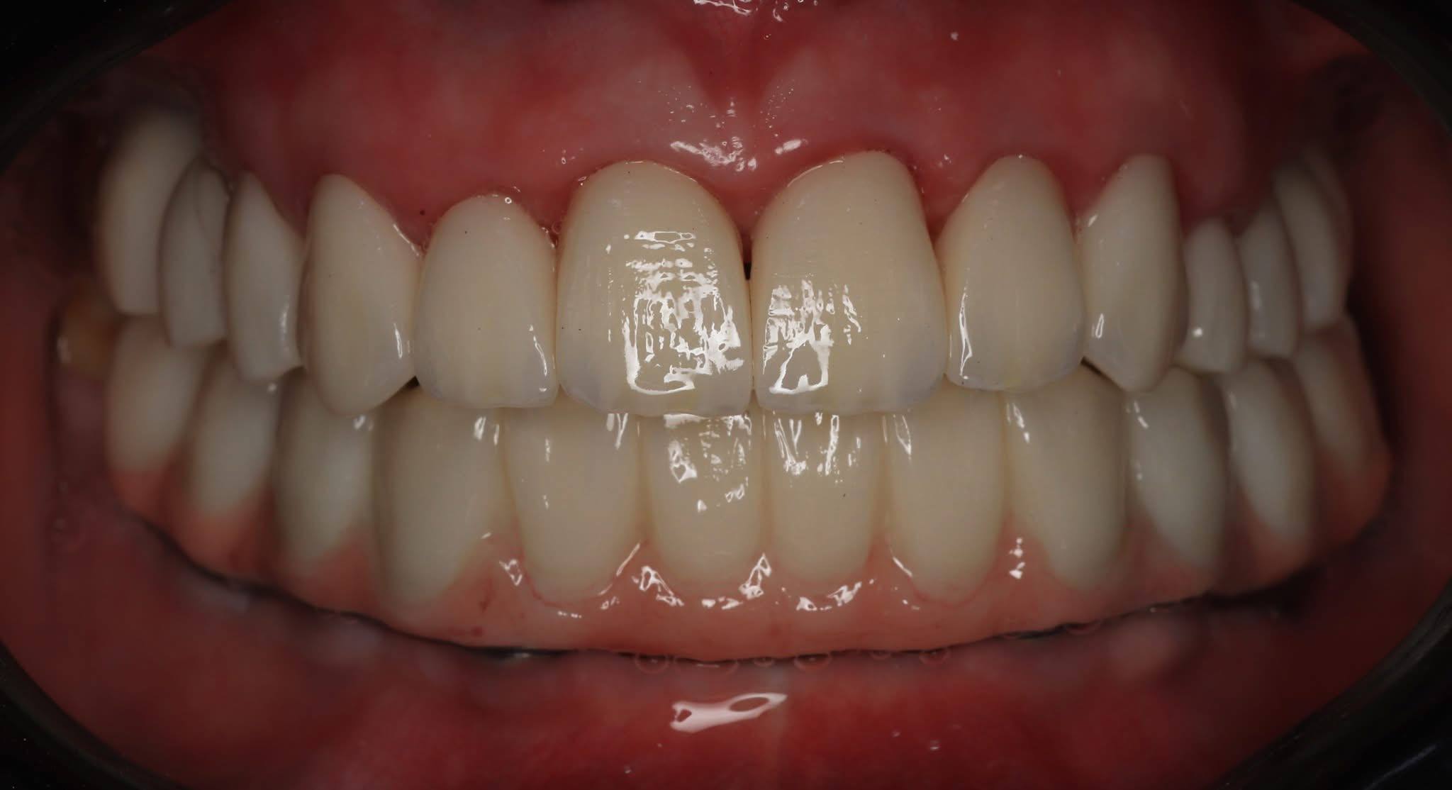 After — Surgical restoration