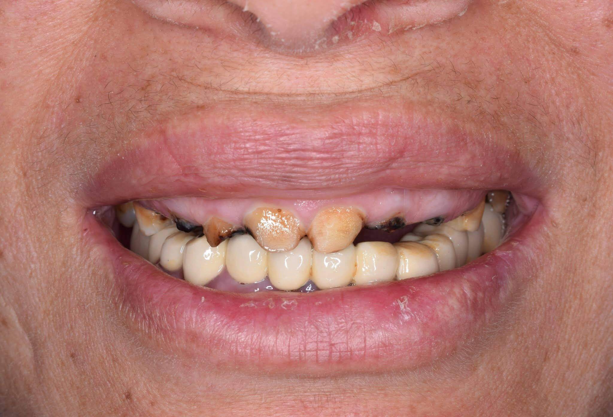 Before — Full mouth restoration