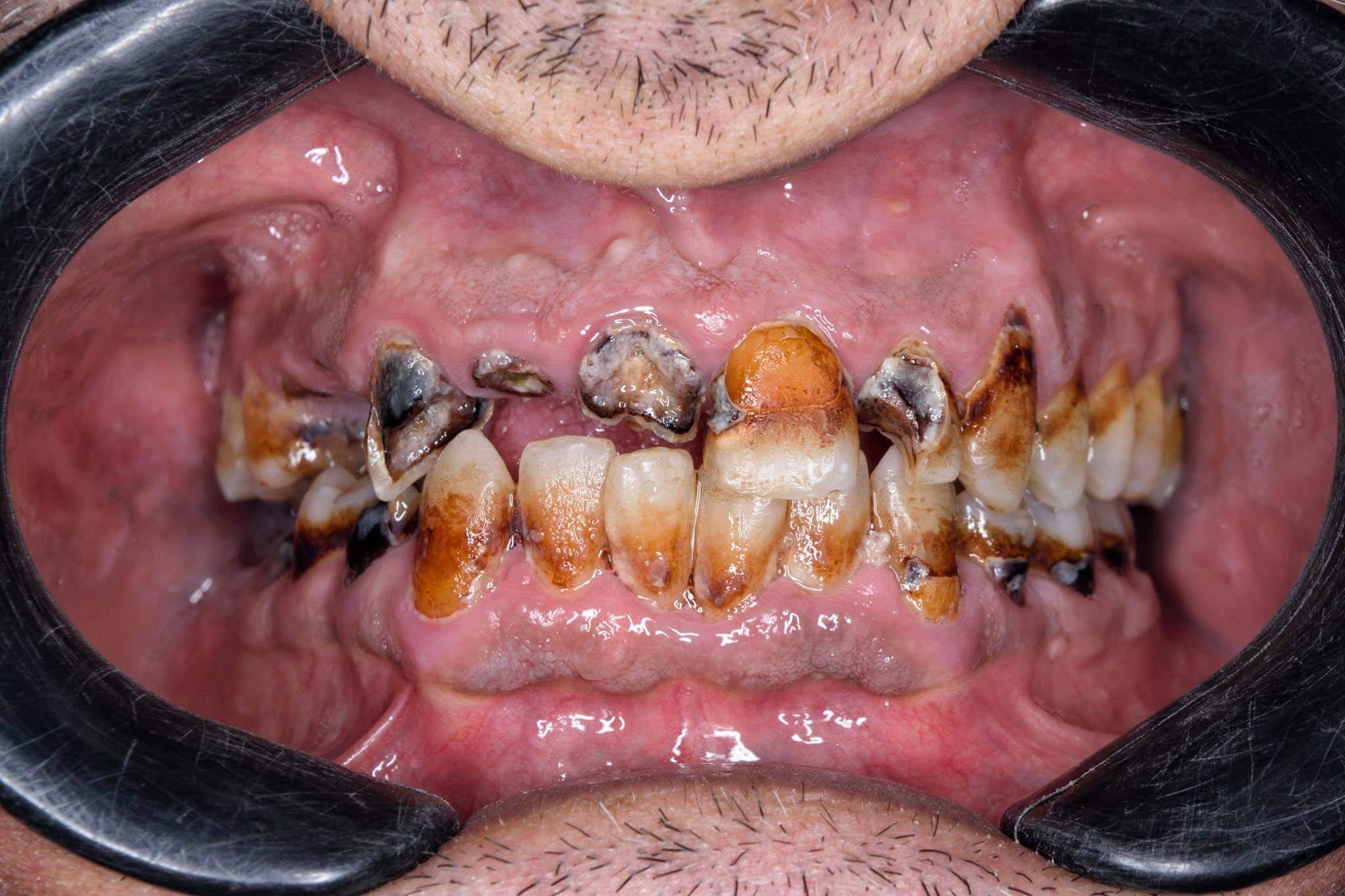 Before — Smile makeover