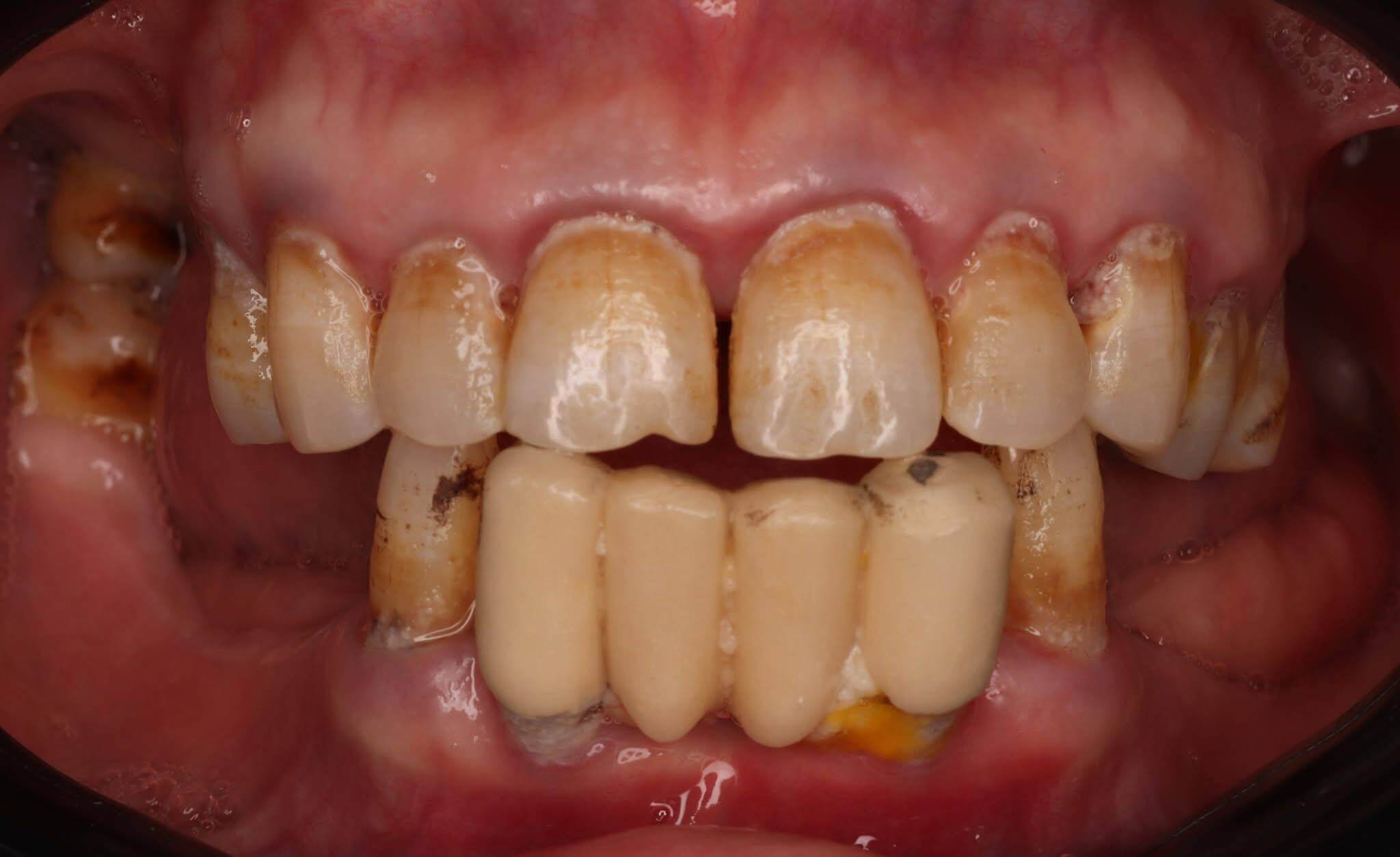 Before — Surgical restoration
